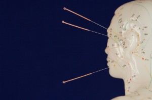 acupuncture and pain management