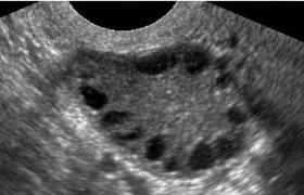 PCOS now PMOS